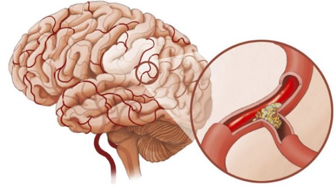 дистония сосудов головного мозга