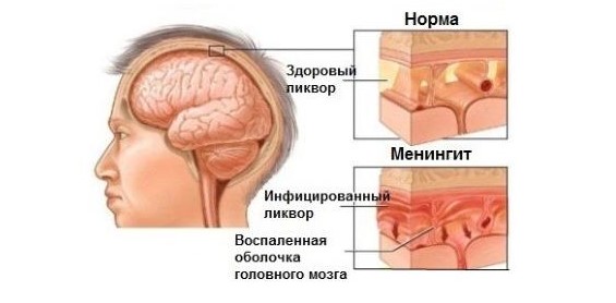 Изображение - Мышечная гипотония sindrom-myshechnoj-gipotonii-2