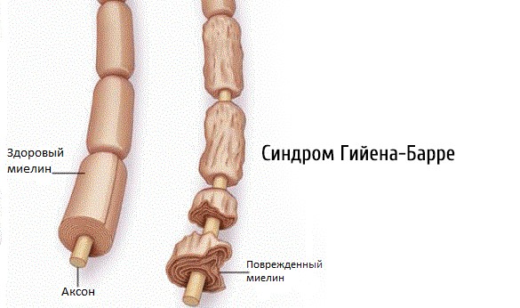 Изображение - Мкб мышечная гипотония код мкб sindrom-myshechnoj-gipotonii-4