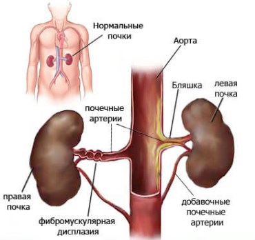 Фибромускулярная дисплазия артерии и почечное давление