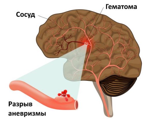Изображение - Повышенное внутричерепное давление симптомы у взрослых priznaki-vnutricherepnogo-davleniya-u-vzroslyh-2