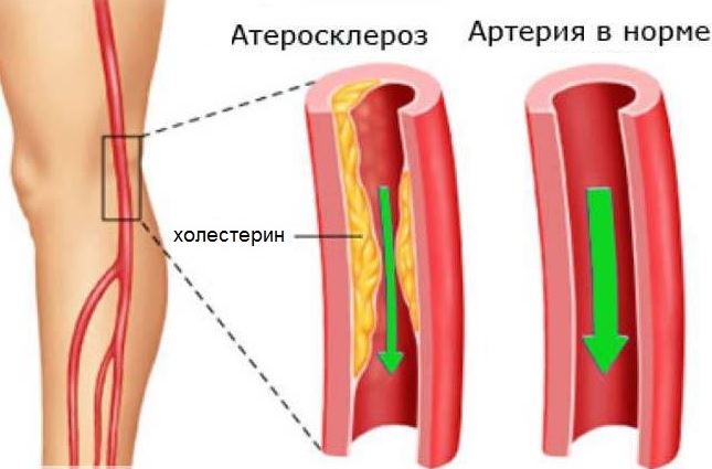 Атеросклероз при гипертонии