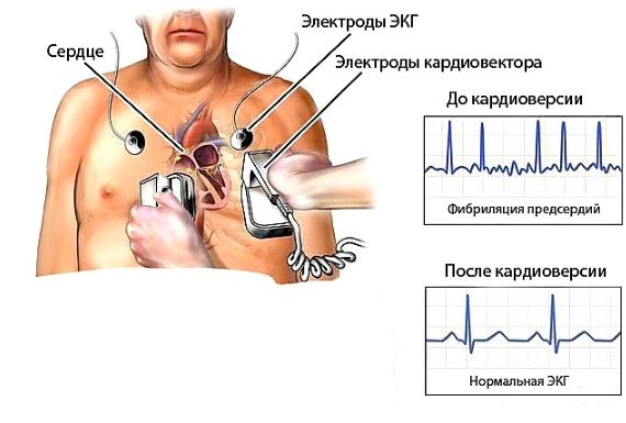 Электроимпульсная кардиоверсия