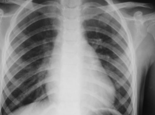 Увеличение тени сердца на рентгенограмме