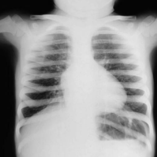Рентгенограмма при тетраде Фалло