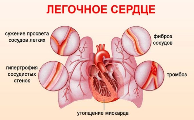 Блокада правой ножки пучка гиса на экг фото