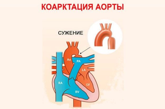 Коарктация аорты