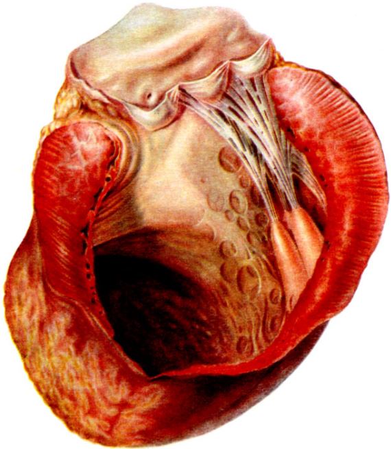 Острая аневризма сердца