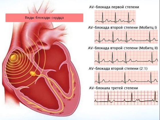 Блокады сердца презентация