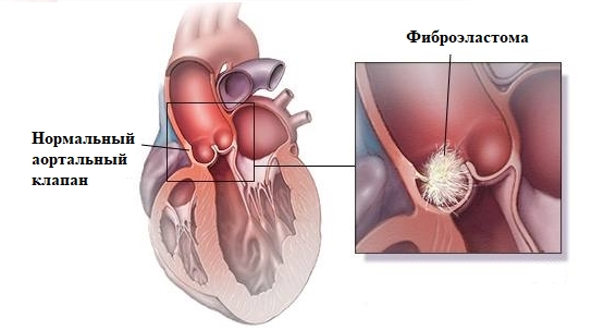 Фиброэластома сердца