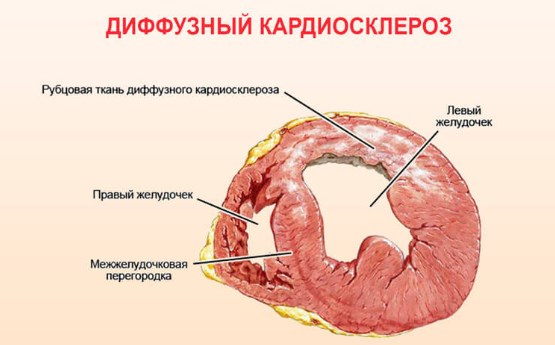 Постмиокардический кардиосклероз