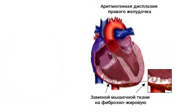 Аритмогенная дисплазия правого желудочка сердца