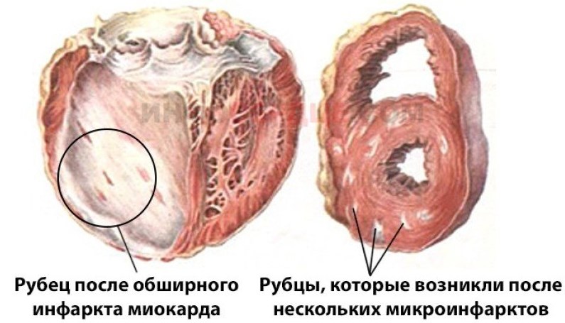 Постинфарктный фиброз