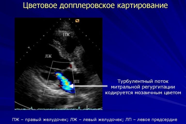 Что такое эхокардиография сердца как делают женщинам фото