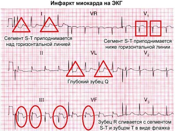 Инфаркт миокарда на ЭКГ
