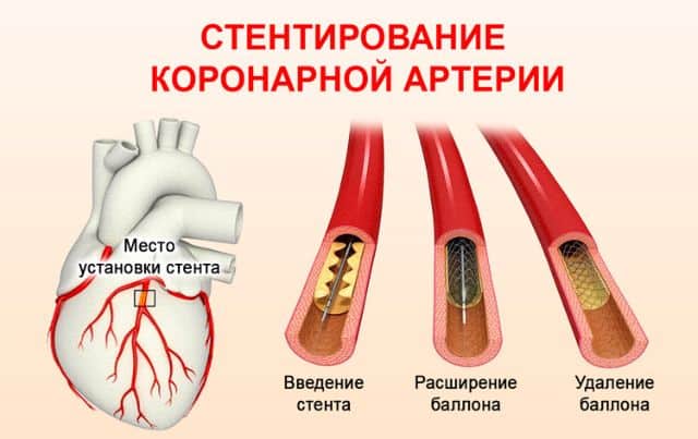 Стентирование коронарной артерии