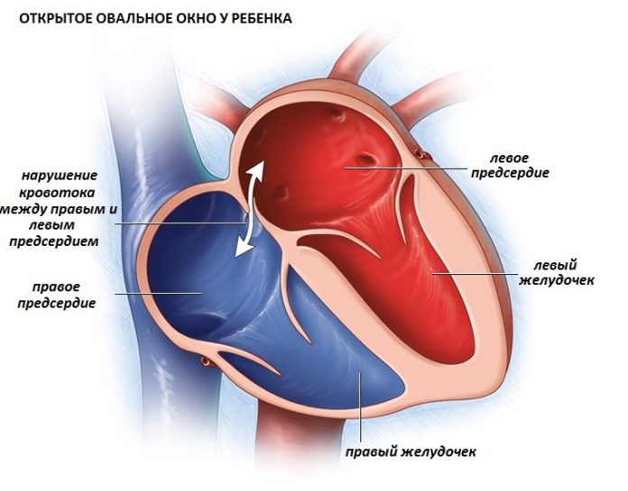 Открытое овальное окно в сердце у ребенка, новорожденного
