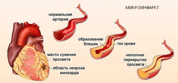 Микроинфаркт