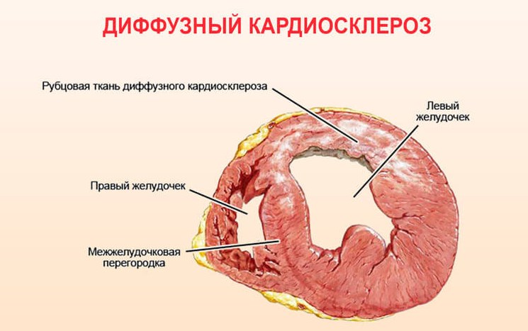 Кардиосклероз сердца
