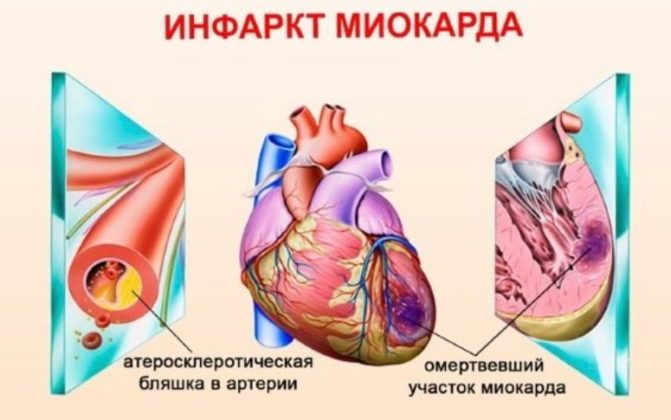 Кардиосклероз: что это такое, как его как лечить, симптомы