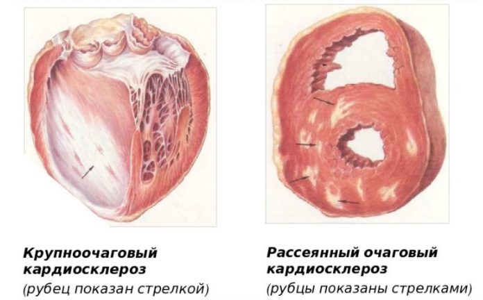 Кардиосклероз: что это такое, как его как лечить, симптомы