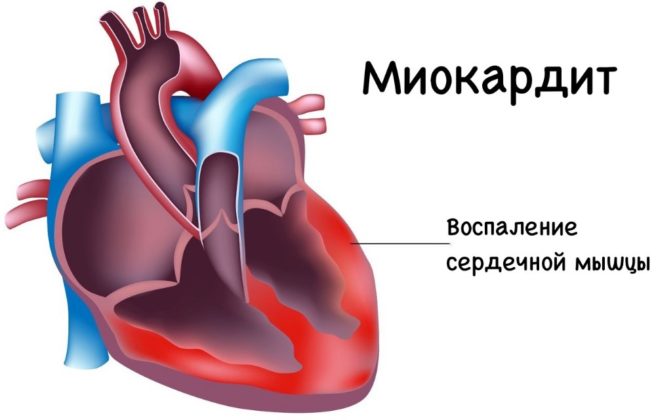 Постинфарктный кардиосклероз карта вызова