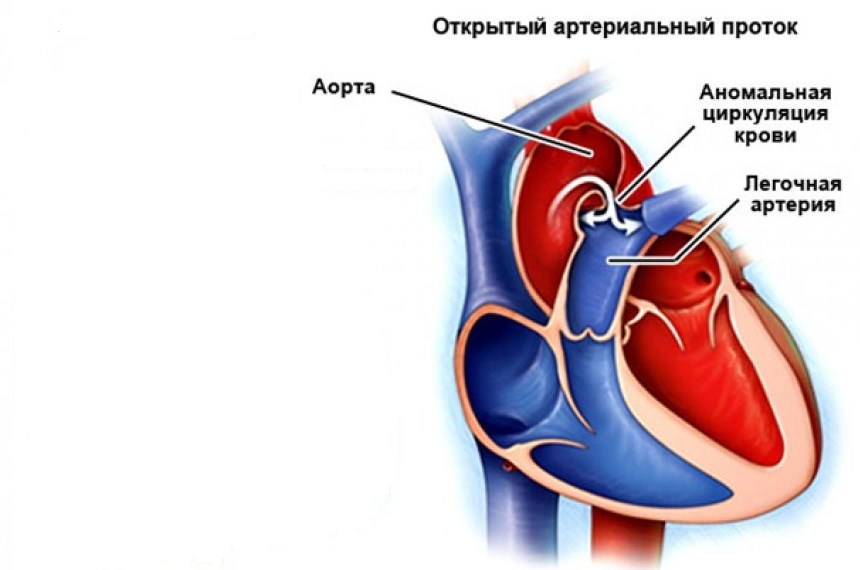 Оап у новорожденных. Открытый артериальный (боталлов) проток. Открытый аортальный проток. ВПС открытый артериальный проток. Открытый артериальный проток рентген.