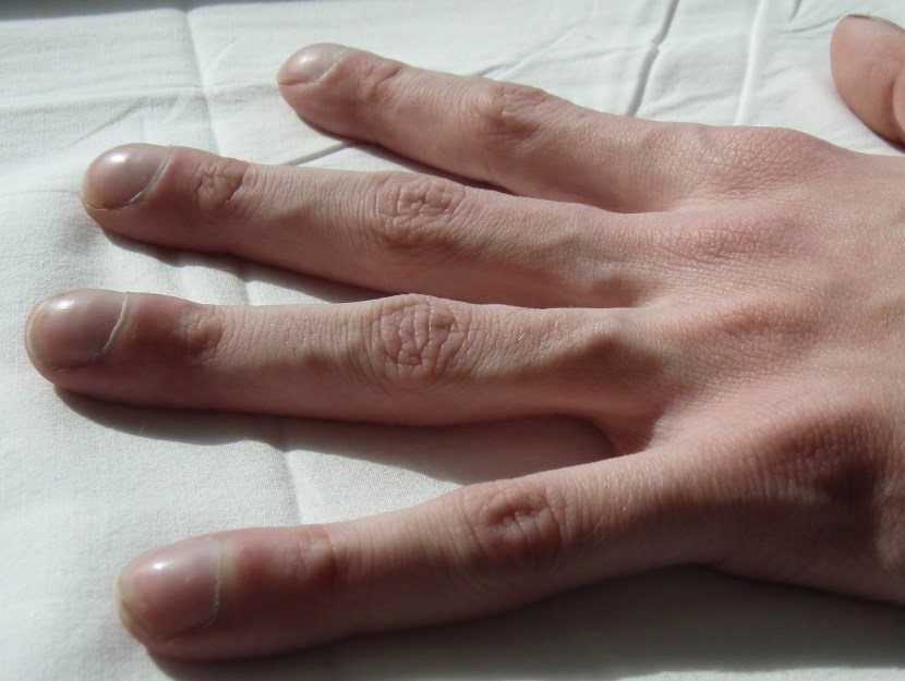 Деформация пальцев рук по типу барабанных палочек