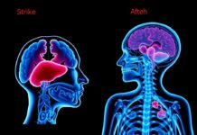 Инсульт как осложнение сердечно-сосудистых заболеваний и восстановление речи: что важно знать и с чего начинать Инсульт как осложнение сердечно-сосудистых заболеваний и восстановление речи: что важно знать и с чего начинать