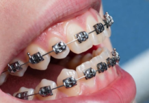 Металлические, керамические или сапфировые? Как выбрать материал брекетов