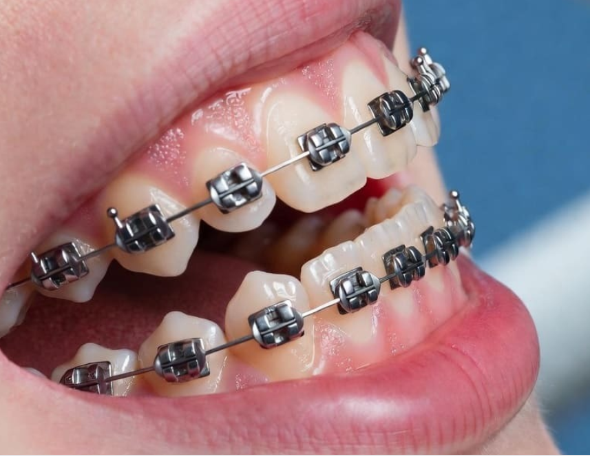 Металлические, керамические или сапфировые? Как выбрать материал брекетов